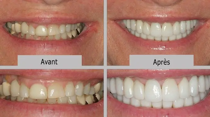 La facette dentaire est une fine pellicule de céramique qui sera collée sur  la dent afin d'en améliorer l'aspect visuel. Les facettes sont rapides à  poser..