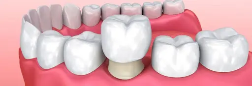 couronne dentaire Tunisie