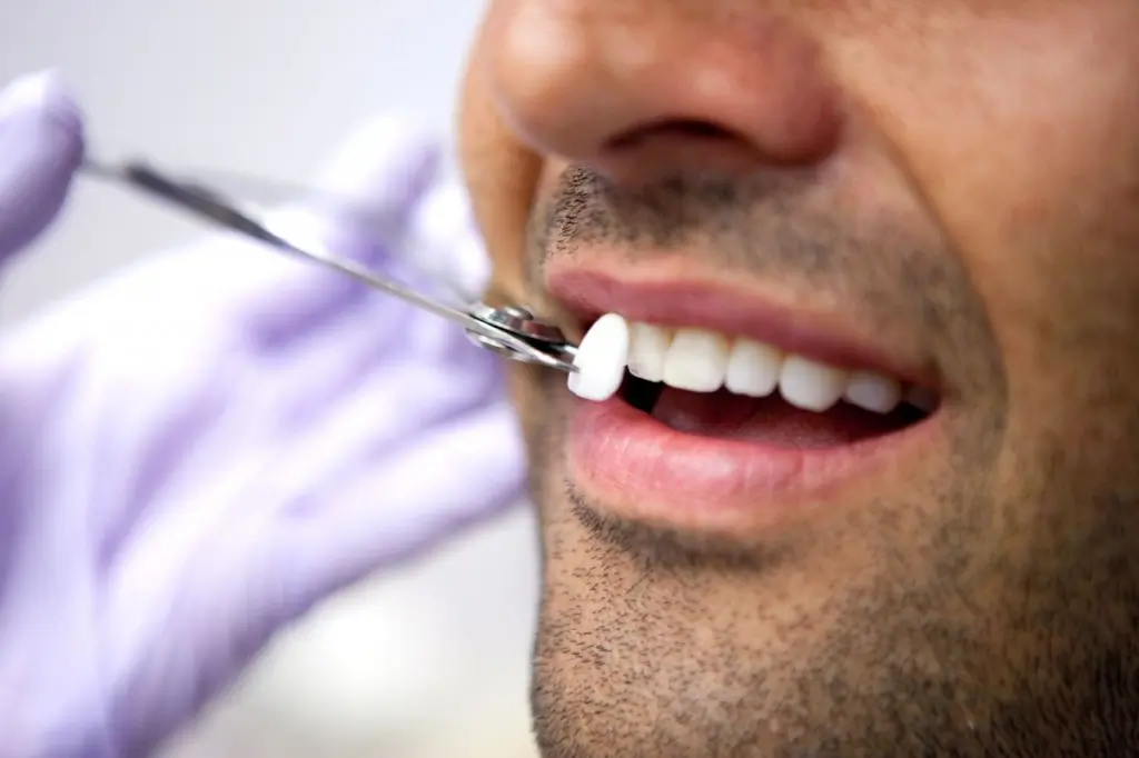 facettes dentaire pour modifier la forme des dents