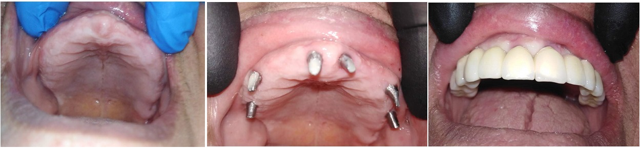 implant dentaire Tunisie avant après